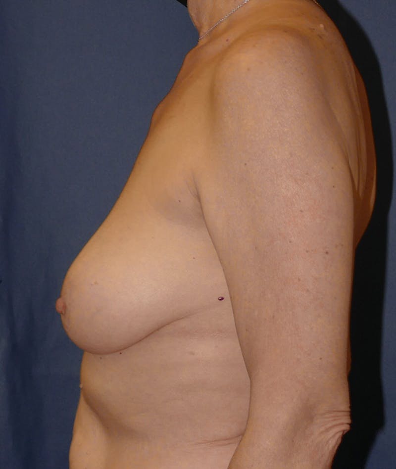 Breast Lift Before & After Gallery - Patient 349278 - Image 9