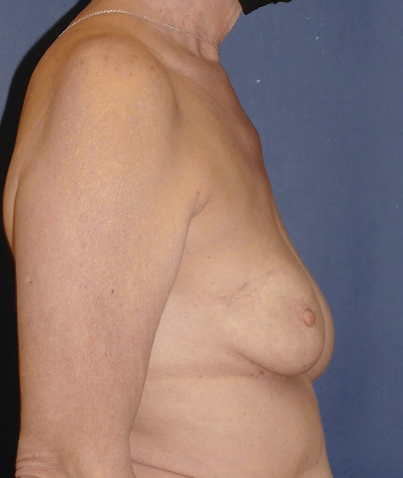 Breast Lift Before & After Gallery - Patient 349278 - Image 5