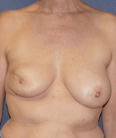 Breast Reconstruction with Autologous Tissue Before & After Gallery - Patient 296206 - Image 1