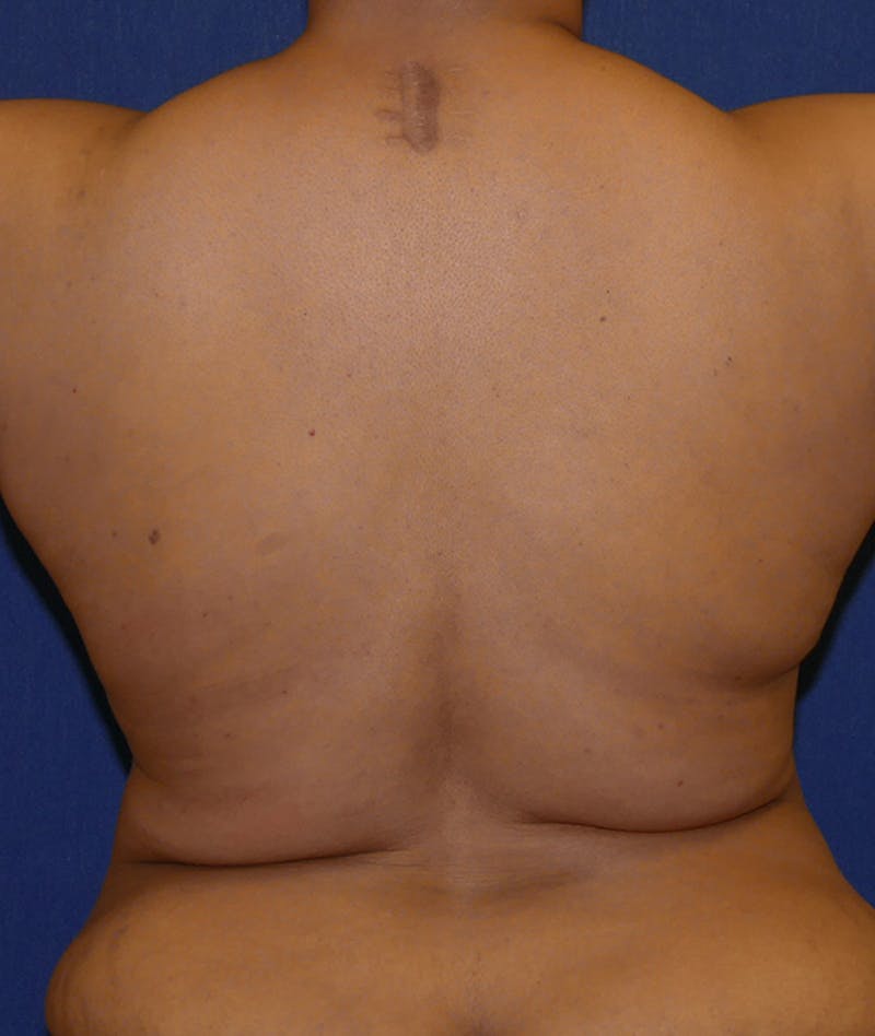 Breast Reconstruction with Autologous Tissue Before & After Gallery - Patient 119852 - Image 11
