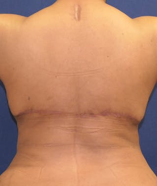 Breast Reconstruction with Autologous Tissue Before & After Gallery - Patient 119852 - Image 12