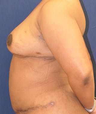 Breast Reconstruction with Autologous Tissue Before & After Gallery - Patient 119852 - Image 10