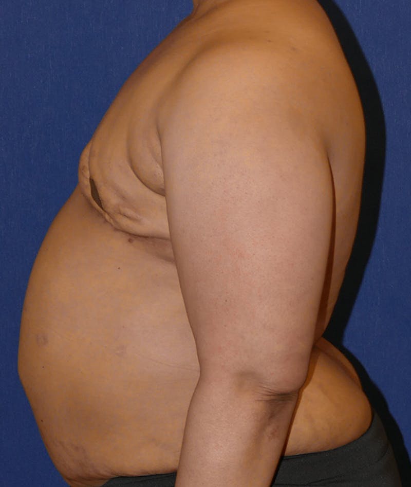 Breast Reconstruction with Autologous Tissue Before & After Gallery - Patient 119852 - Image 9