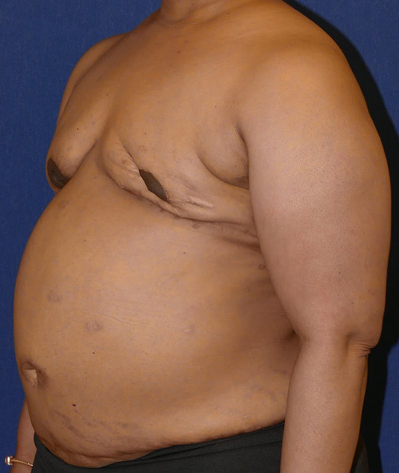 Breast Reconstruction with Autologous Tissue Before & After Gallery - Patient 119852 - Image 7