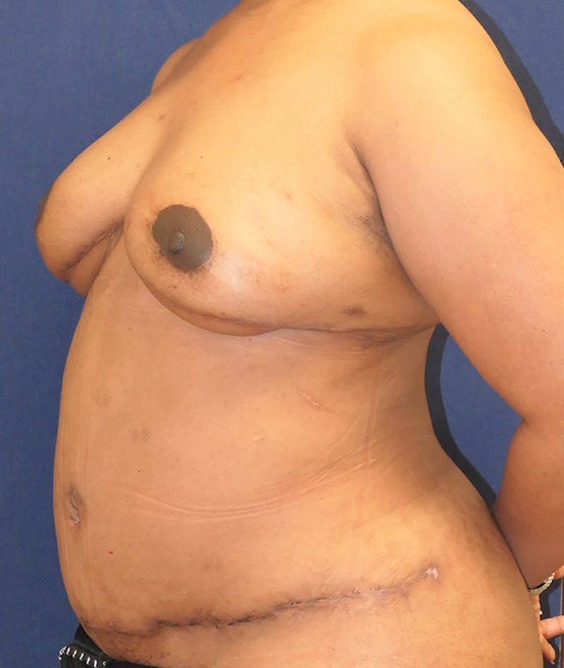 Breast Reconstruction with Autologous Tissue Before & After Gallery - Patient 119852 - Image 8