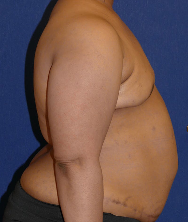 Breast Reconstruction with Autologous Tissue Before & After Gallery - Patient 119852 - Image 5