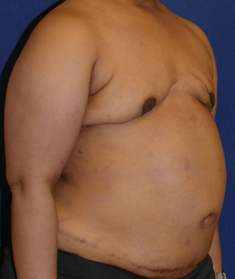 Breast Reconstruction with Autologous Tissue Before & After Gallery - Patient 119852 - Image 3