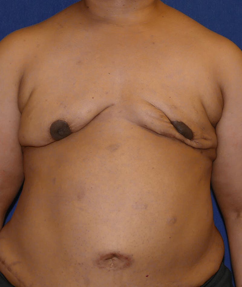 Breast Reconstruction with Autologous Tissue Before & After Gallery - Patient 119852 - Image 1