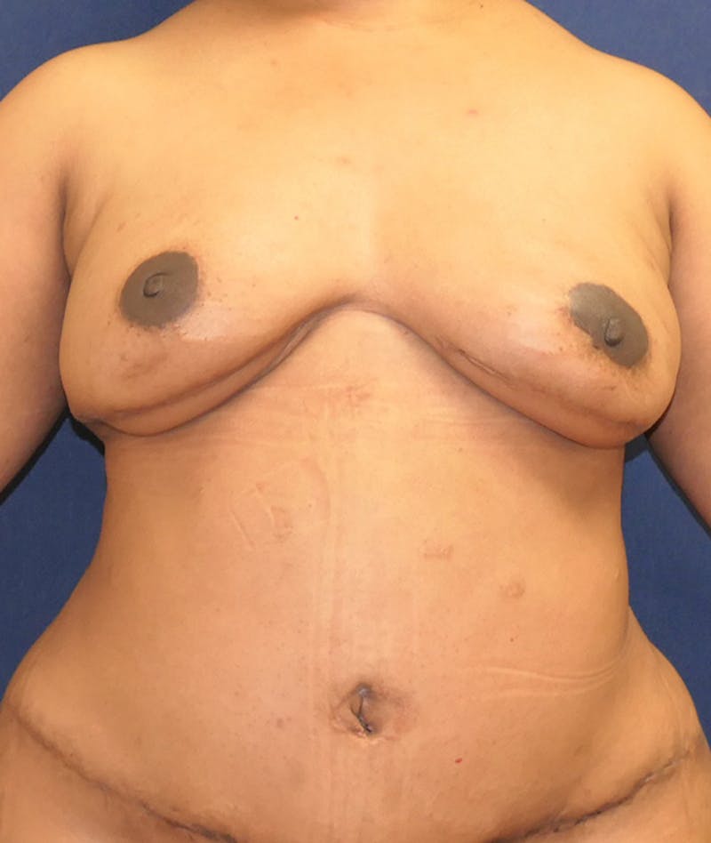Breast Reconstruction with Autologous Tissue Before & After Gallery - Patient 119852 - Image 2