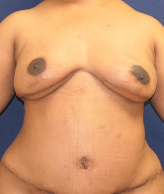 Breast Reconstruction with Autologous Tissue Before & After Gallery - Patient 119852 - Image 2