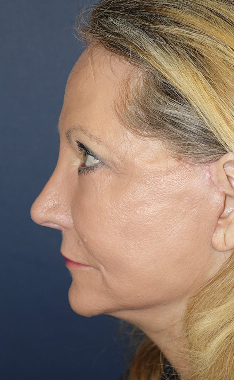 Facelift Before & After Gallery - Patient 346910 - Image 10