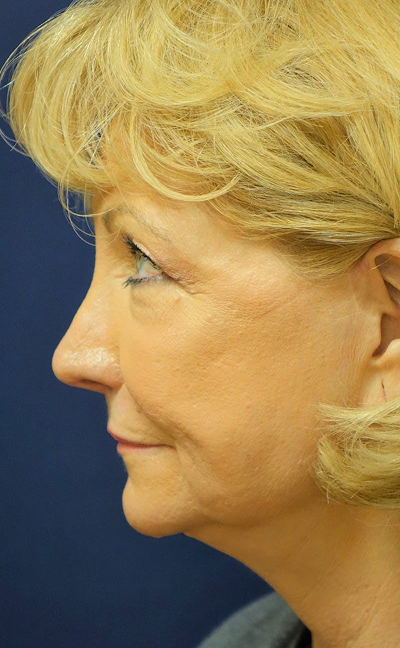 Facelift Before & After Gallery - Patient 346910 - Image 9