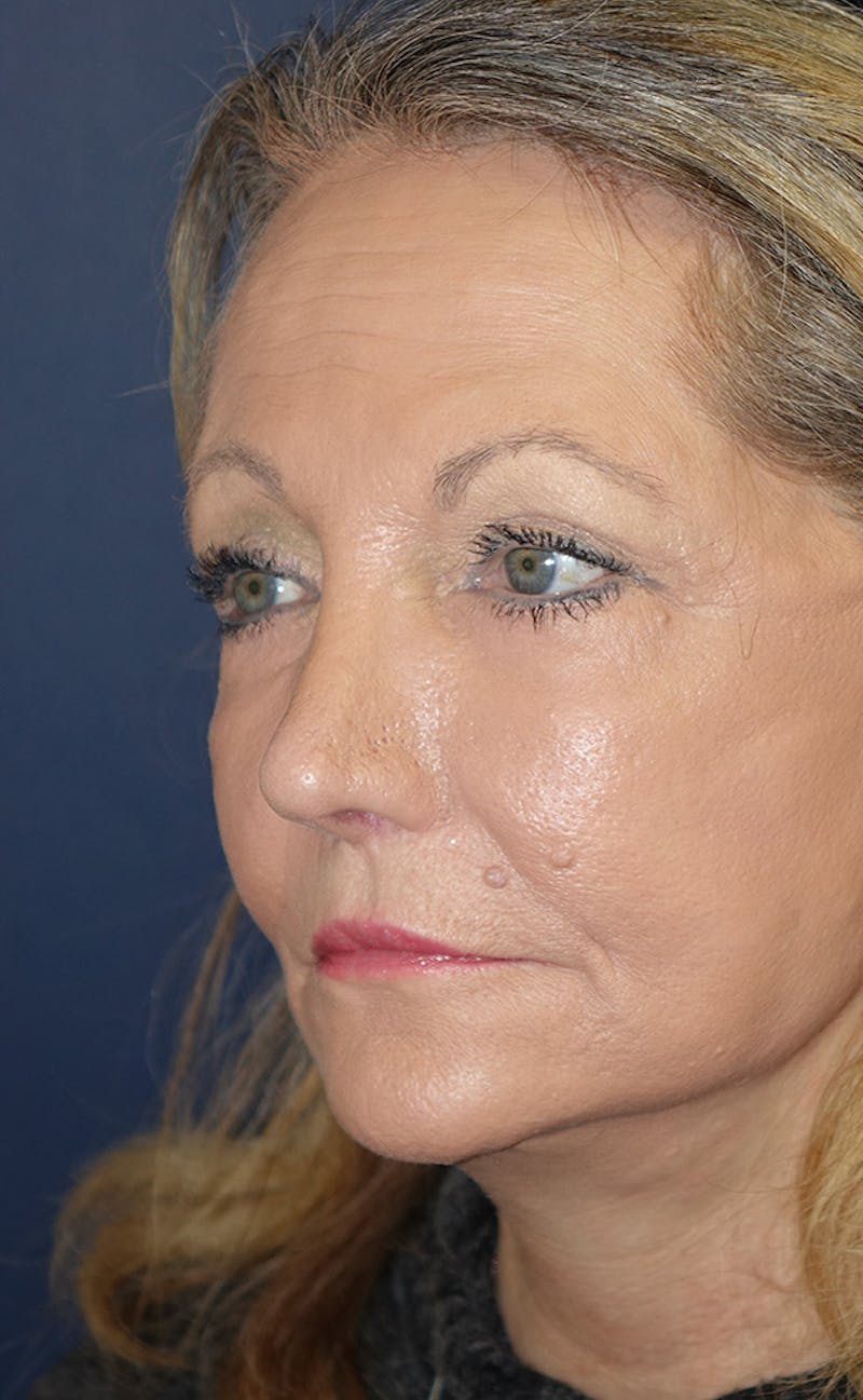 Facelift Before & After Gallery - Patient 346910 - Image 8