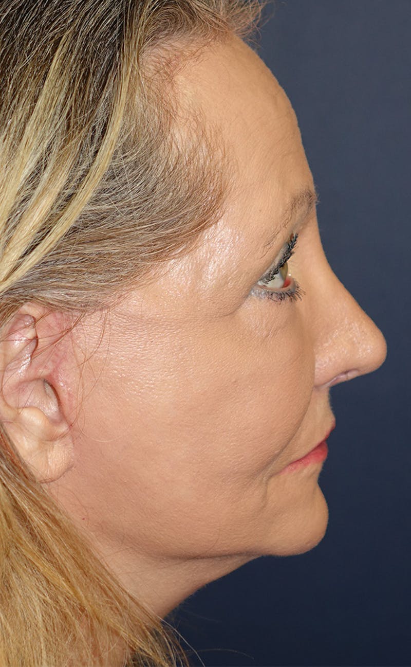 Facelift Before & After Gallery - Patient 346910 - Image 6