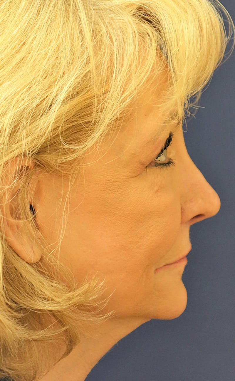 Facelift Before & After Gallery - Patient 346910 - Image 5