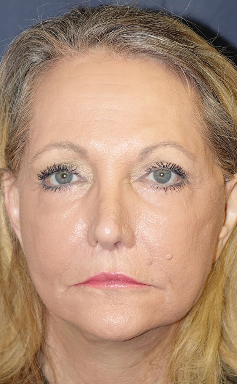 Facelift Before & After Gallery - Patient 346910 - Image 2