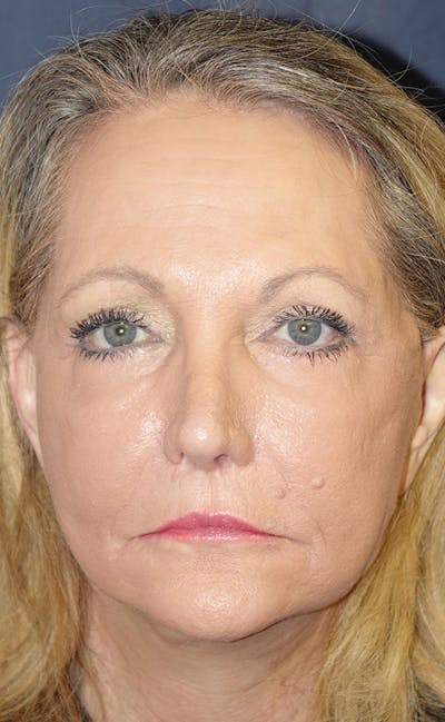 Facelift Before & After Gallery - Patient 346910 - Image 2