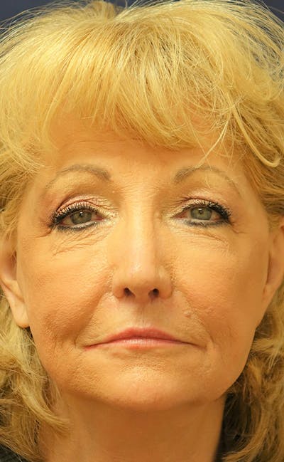 Facelift Before & After Gallery - Patient 346910 - Image 1