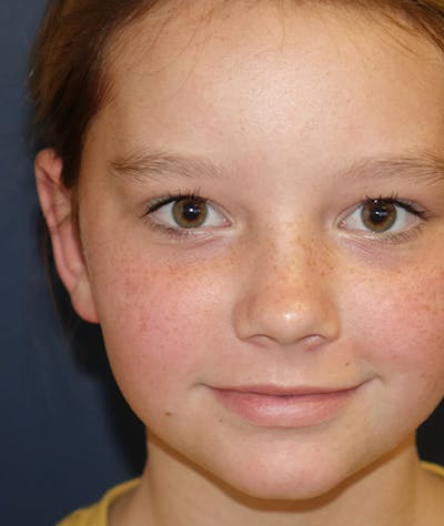 Otoplasty Before & After Gallery - Patient 262732 - Image 2