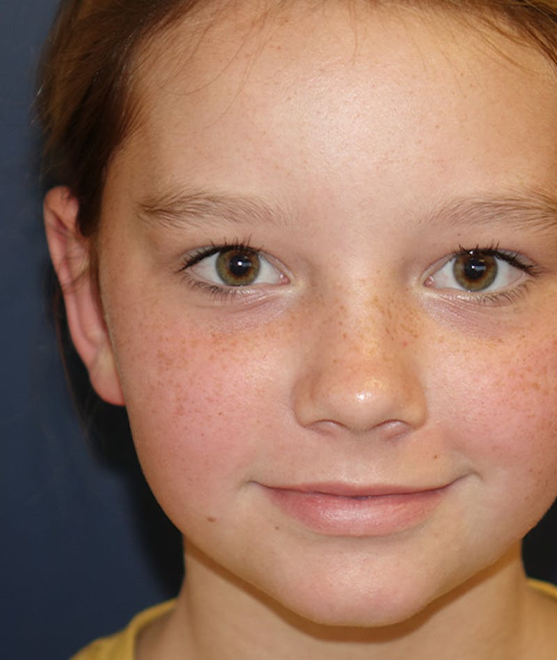 Otoplasty Before & After Gallery - Patient 262732 - Image 2