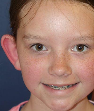Otoplasty Before & After Gallery - Patient 262732 - Image 1