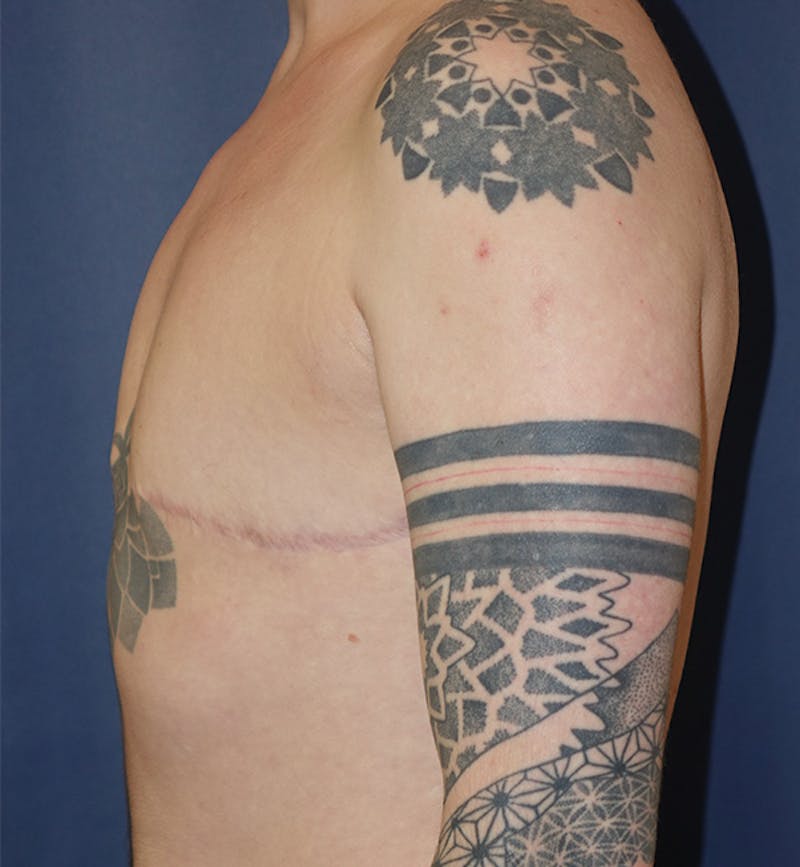 Masculinizing Surgery Before & After Gallery - Patient 130989 - Image 6