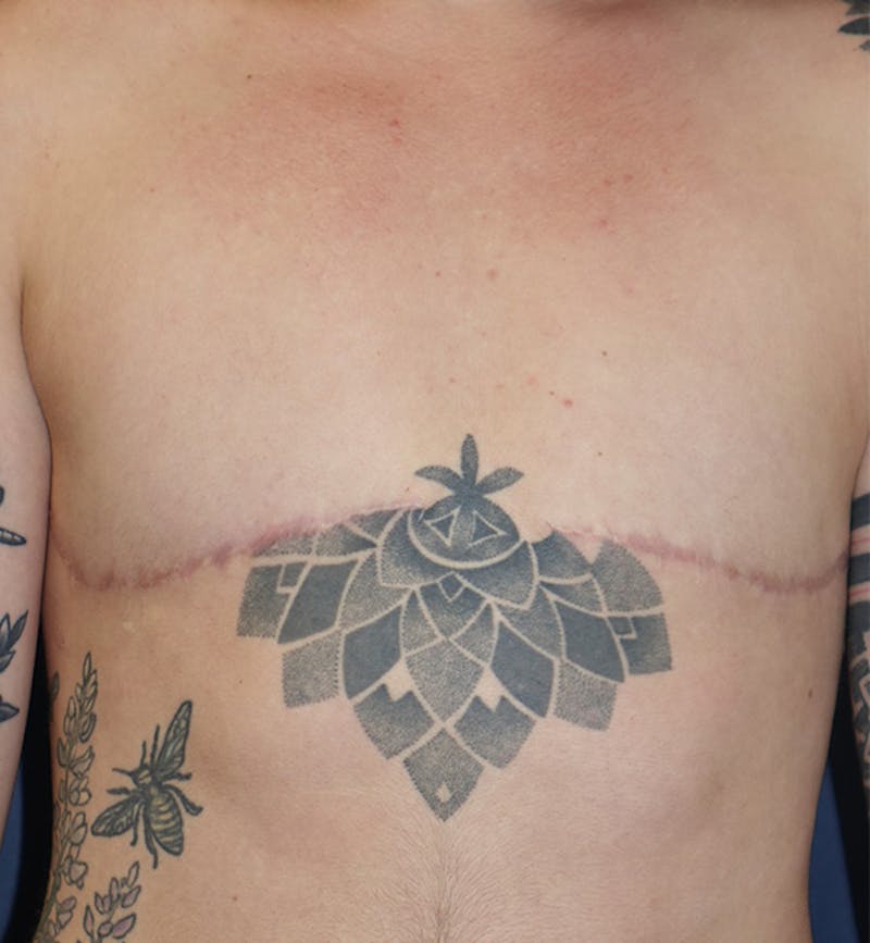 Masculinizing Surgery Before & After Gallery - Patient 130989 - Image 2