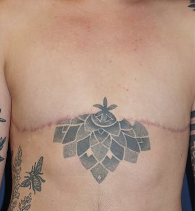 Masculinizing Surgery Before & After Gallery - Patient 130989 - Image 2