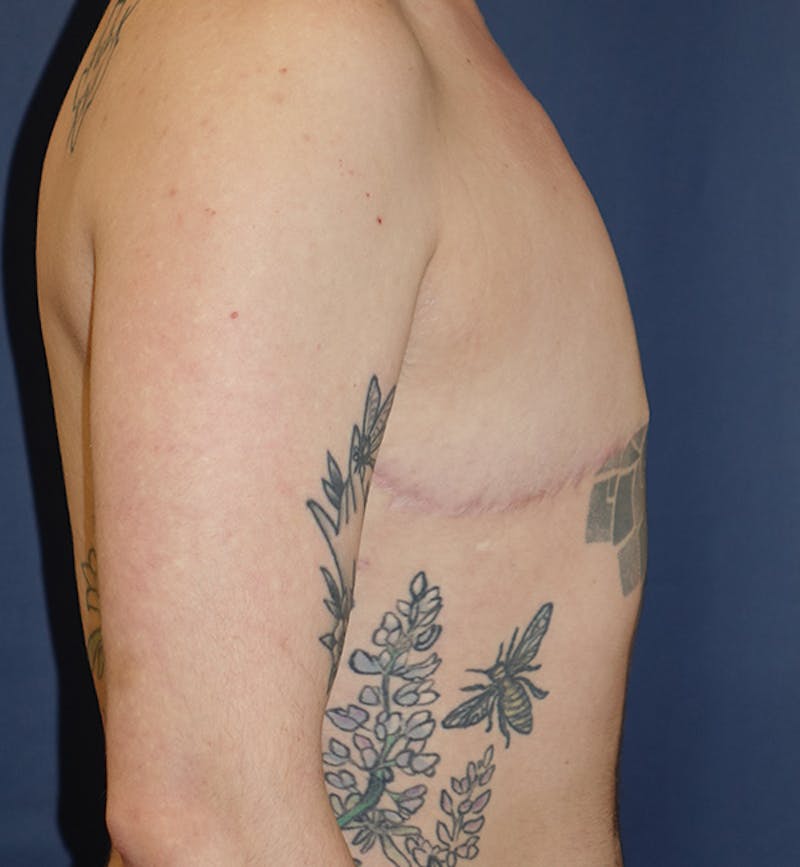 Masculinizing Surgery Before & After Gallery - Patient 130989 - Image 4