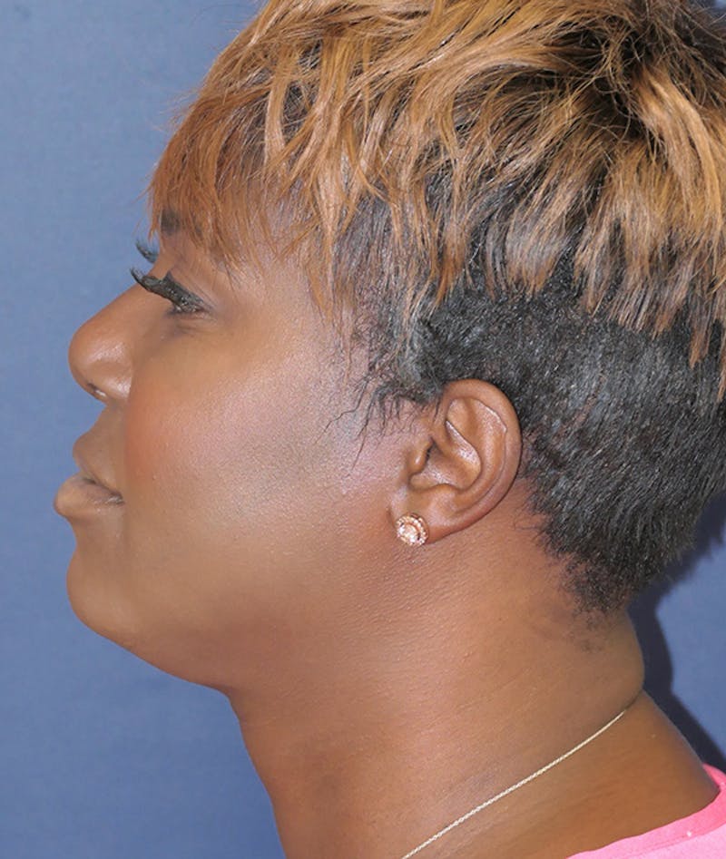 Facial Implant Before & After Gallery - Patient 340986 - Image 6