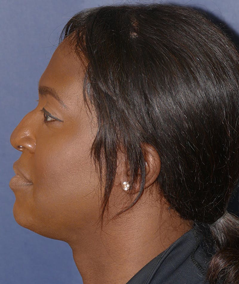 Facial Implant Before & After Gallery - Patient 340986 - Image 5