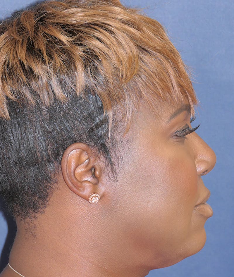 Facial Implant Before & After Gallery - Patient 340986 - Image 4