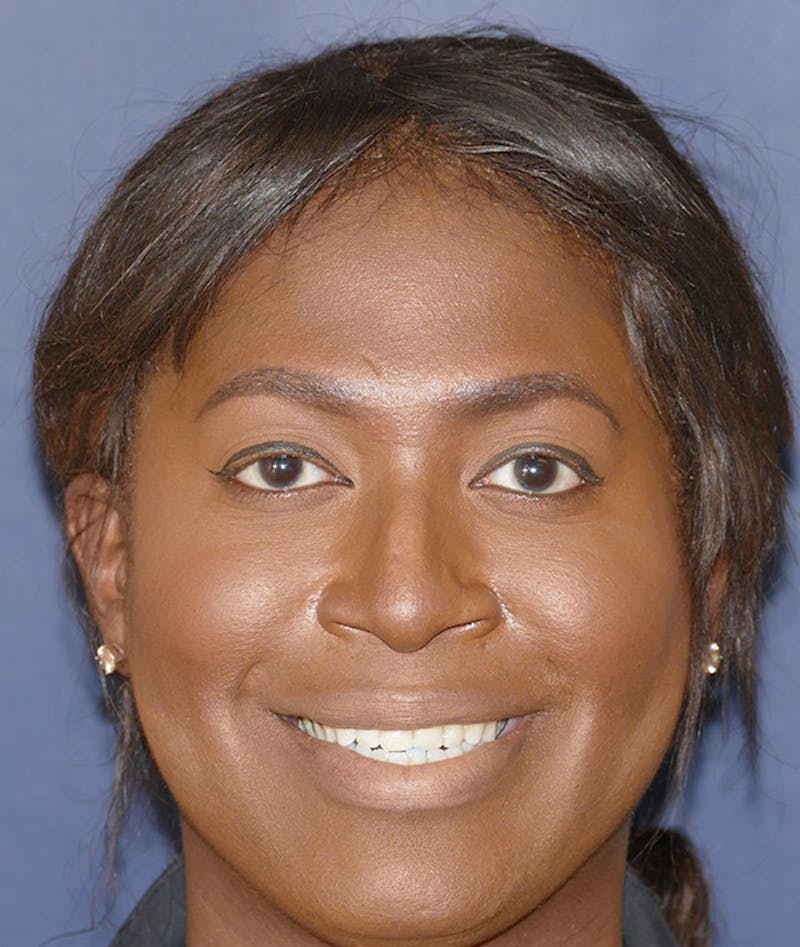 Facial Implant Before & After Gallery - Patient 340986 - Image 1