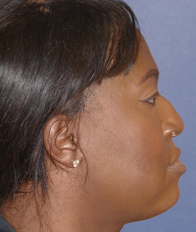 Facial Implant Before & After Gallery - Patient 340986 - Image 3