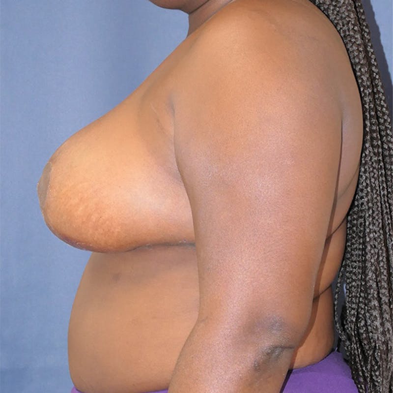 Breast Reduction Before & After Gallery - Patient 265089 - Image 10