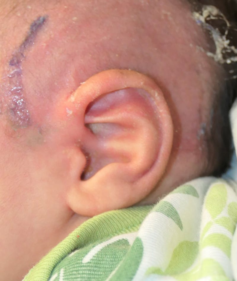 Pediatric Ear Molding Before & After Gallery - Patient 383959 - Image 4
