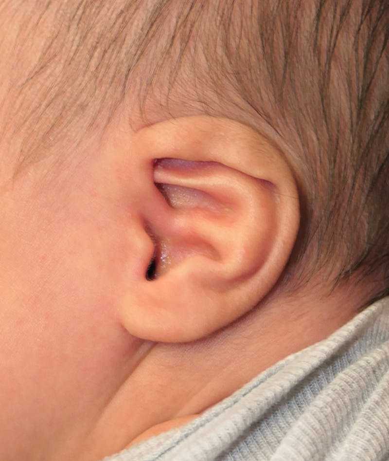 Pediatric Ear Molding Before & After Gallery - Patient 383959 - Image 3