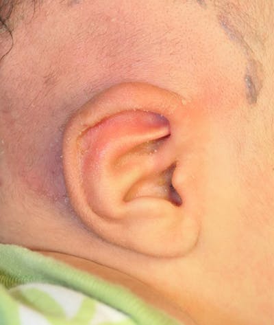 Pediatric Ear Molding Before & After Gallery - Patient 383959 - Image 2
