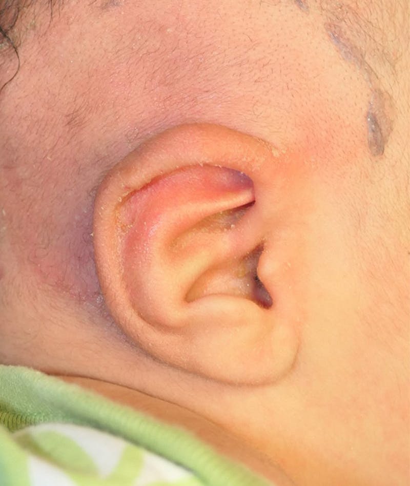 Pediatric Ear Molding Before & After Gallery - Patient 383959 - Image 2