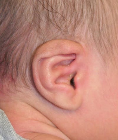 Pediatric Ear Molding Before & After Gallery - Patient 383959 - Image 1