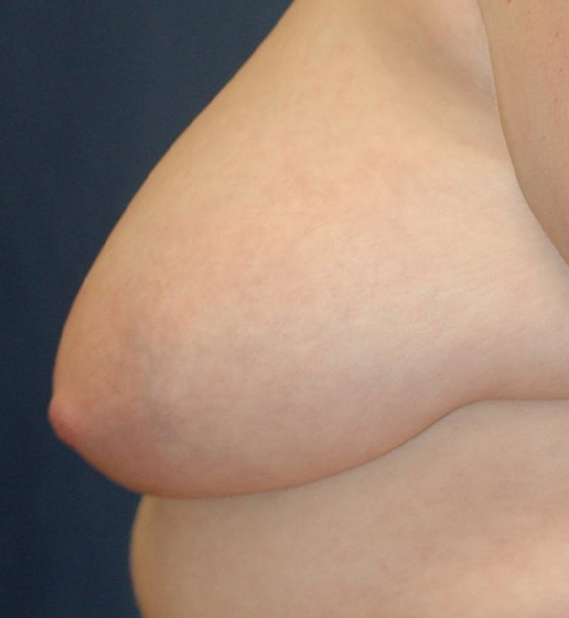 Masculinizing Surgery Before & After Gallery - Patient 272869 - Image 5