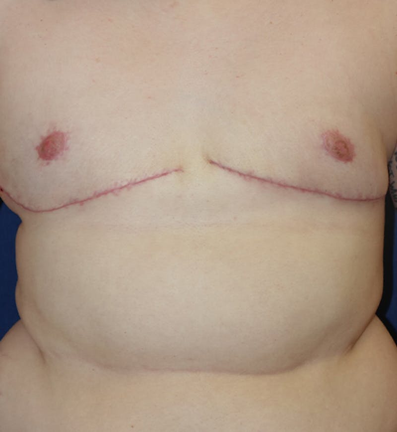 Masculinizing Surgery Before & After Gallery - Patient 272869 - Image 2