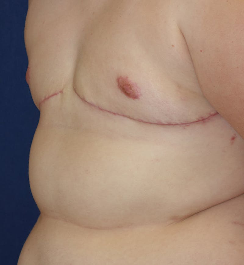 Masculinizing Surgery Before & After Gallery - Patient 272869 - Image 4