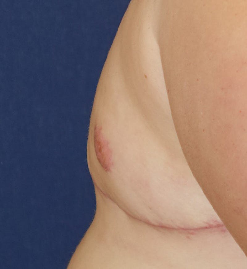 Masculinizing Surgery Before & After Gallery - Patient 272869 - Image 6