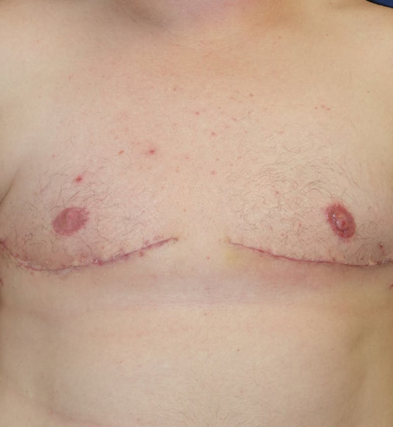 Masculinizing Surgery Before & After Gallery - Patient 285952 - Image 2