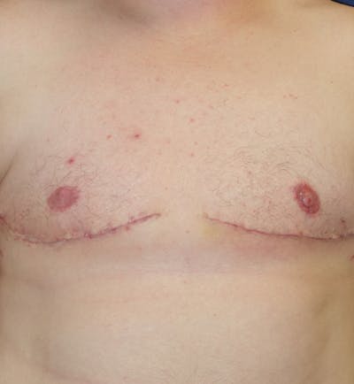 Masculinizing Surgery Before & After Gallery - Patient 285952 - Image 2