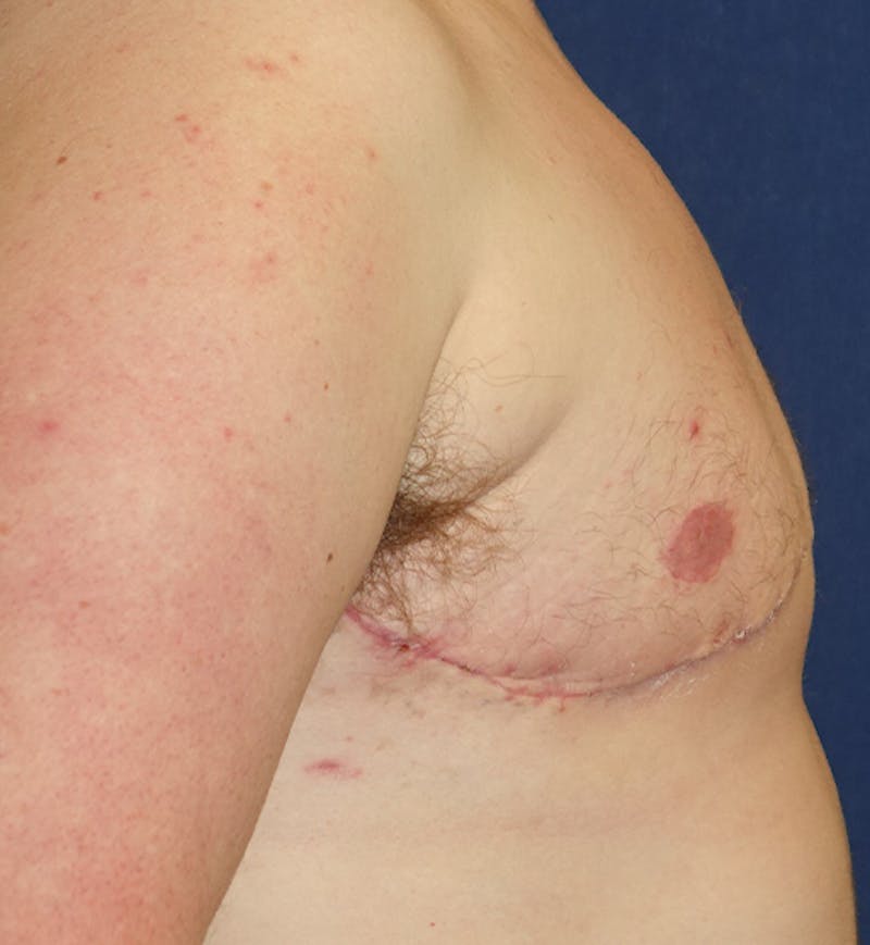 Masculinizing Surgery Before & After Gallery - Patient 285952 - Image 6