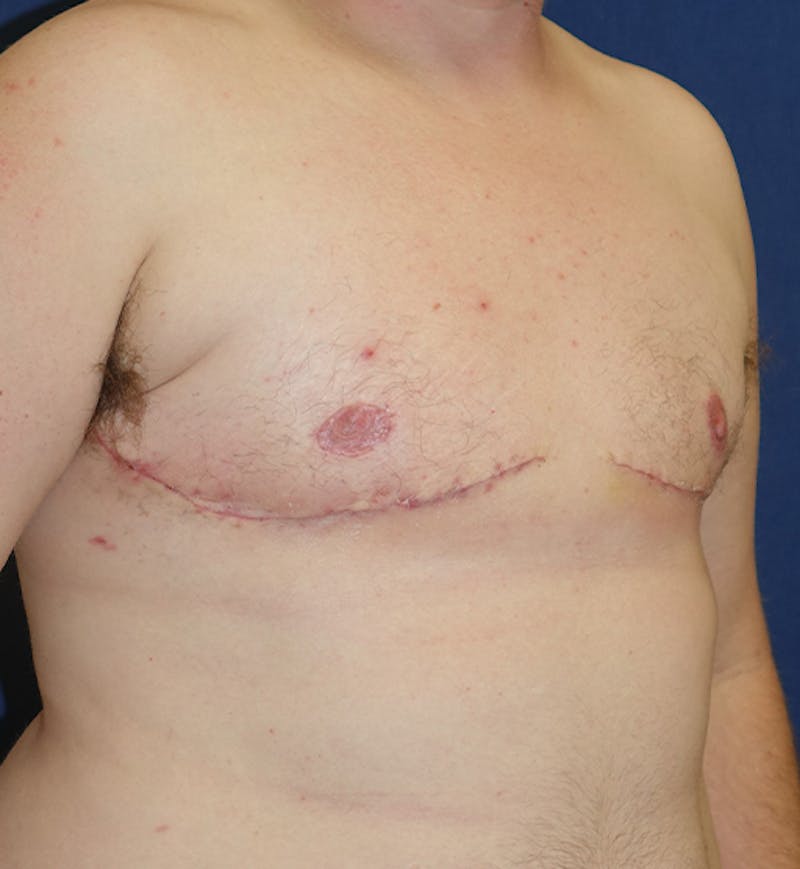 Masculinizing Surgery Before & After Gallery - Patient 285952 - Image 4