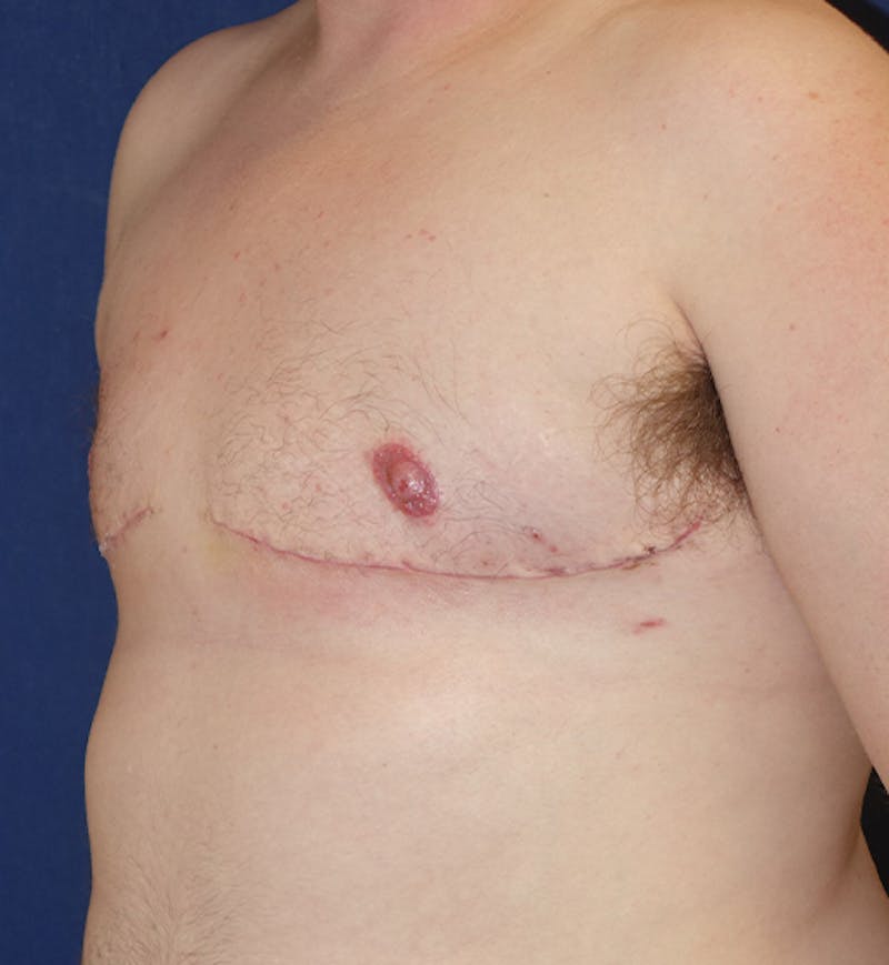 Masculinizing Surgery Before & After Gallery - Patient 285952 - Image 8