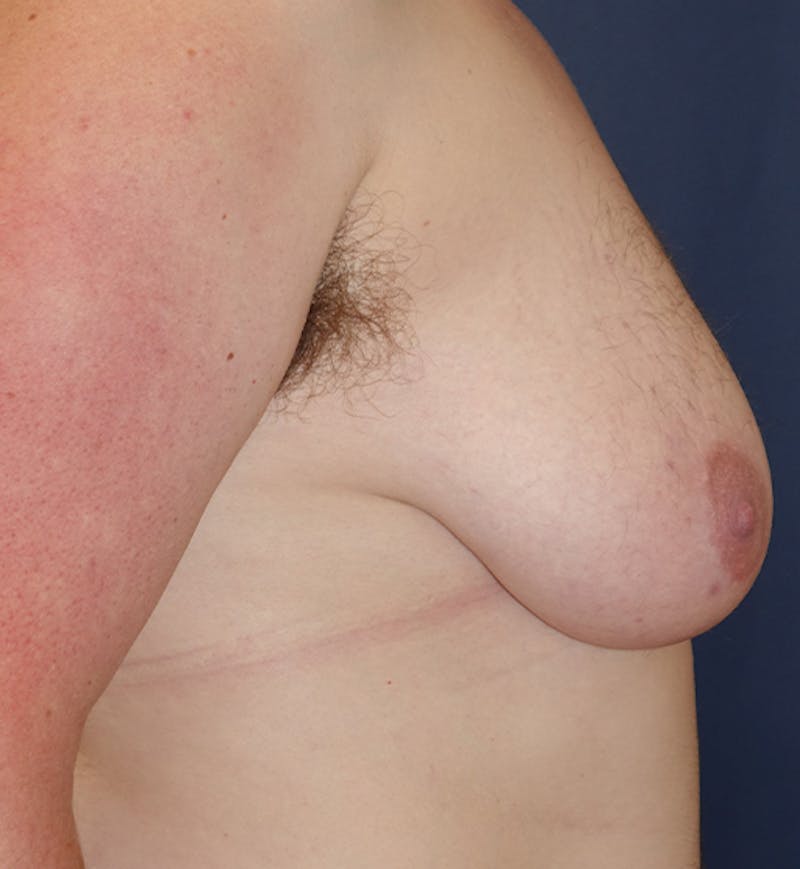 Masculinizing Surgery Before & After Gallery - Patient 285952 - Image 5